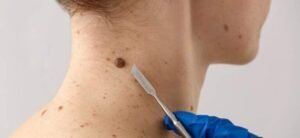 Mutirão gratuito contra câncer de pele em MS acontece em 13 de dezembro